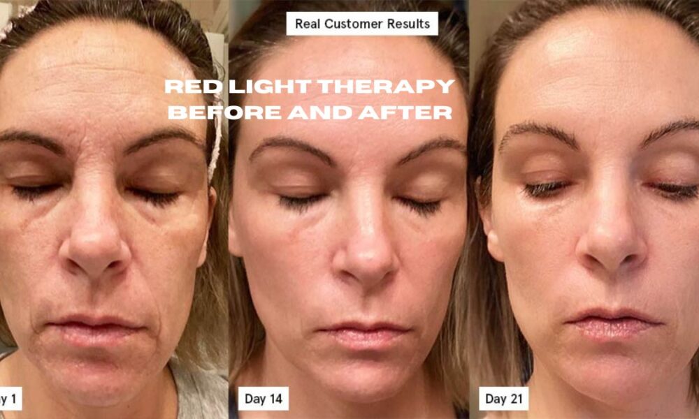 red light therapy before and after