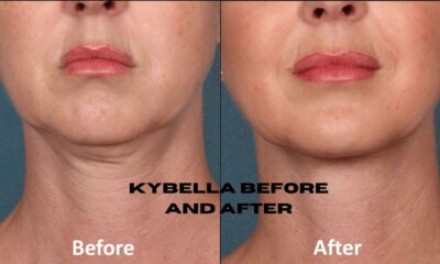 Kybella is a non-surgical treatment that reduces submental fullness, sculpts the jawline and neck contour, and offers noticeable results.