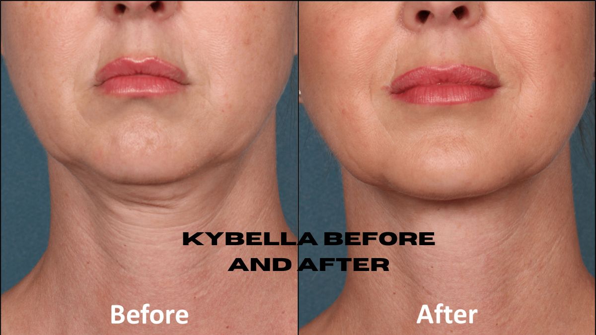 Kybella is a non-surgical treatment that reduces submental fullness, sculpts the jawline and neck contour, and offers noticeable results.